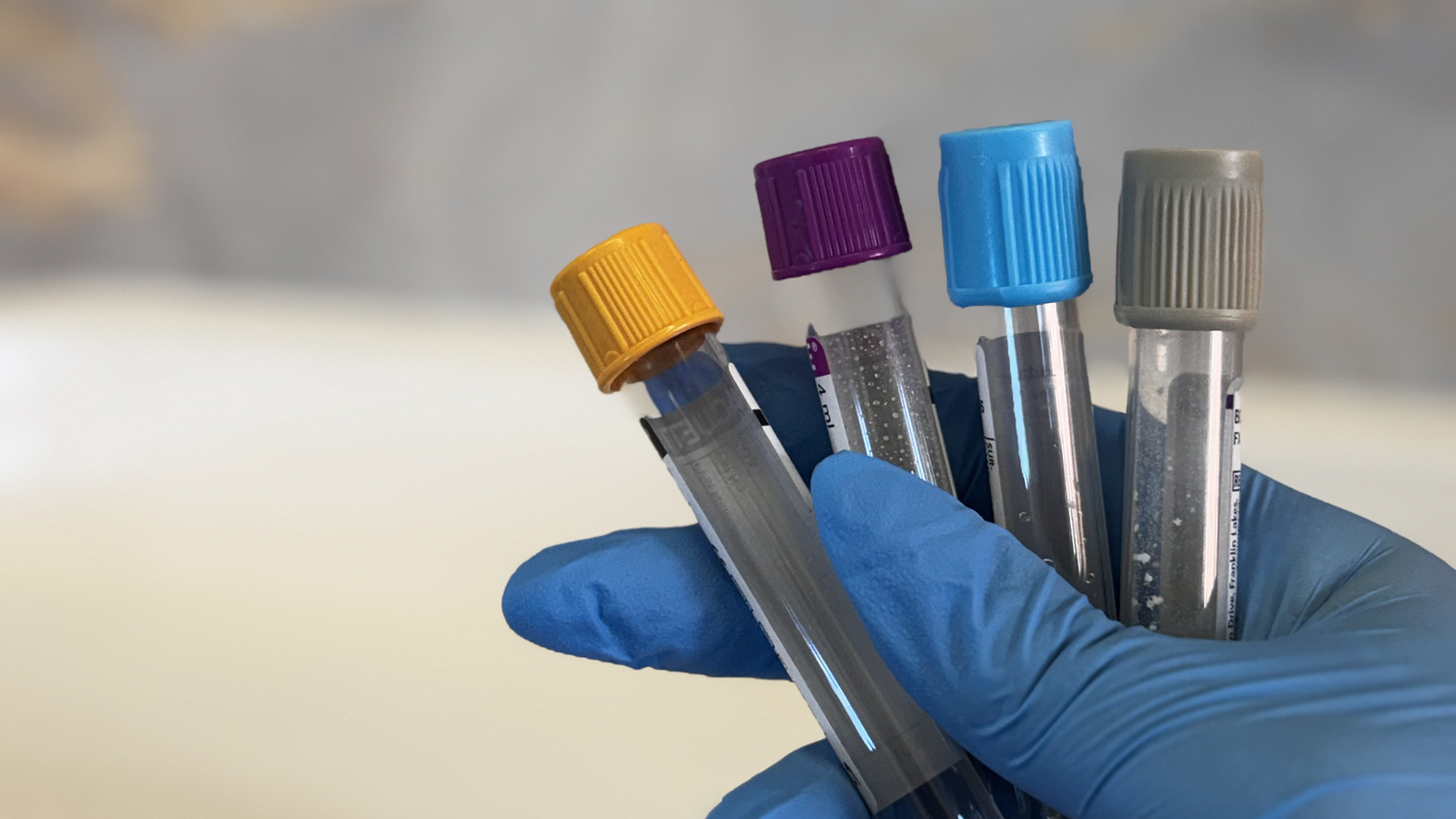 PRP (Platelet Rich Plasma)