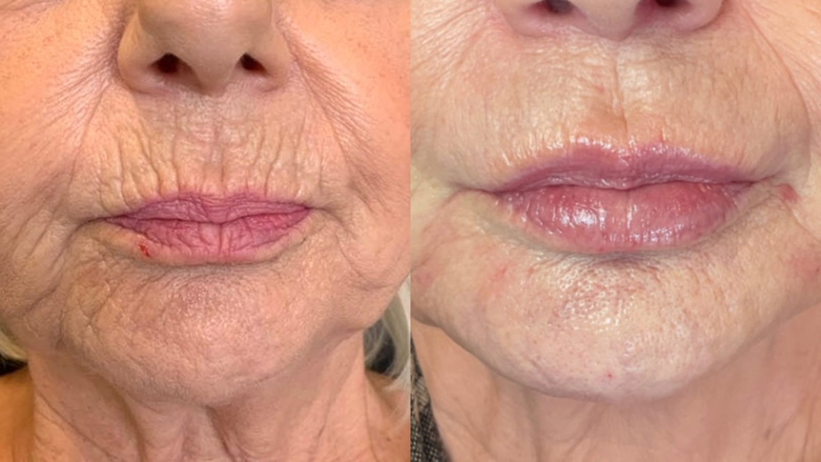 Hydromax — Before & After
