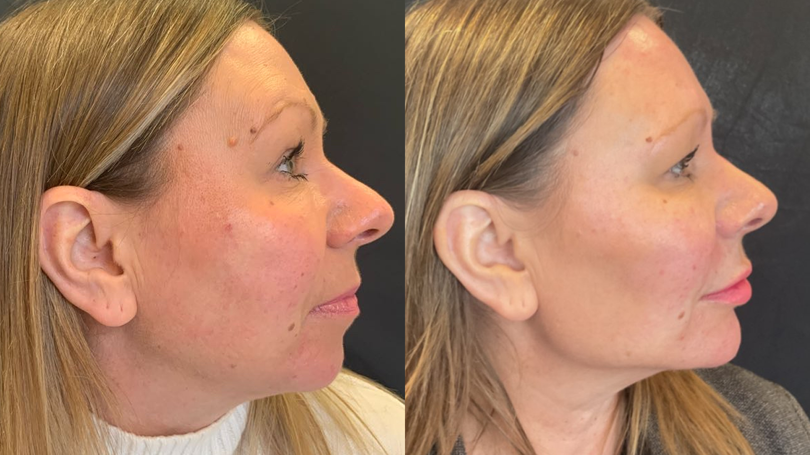Dermal Fillers for the Chin