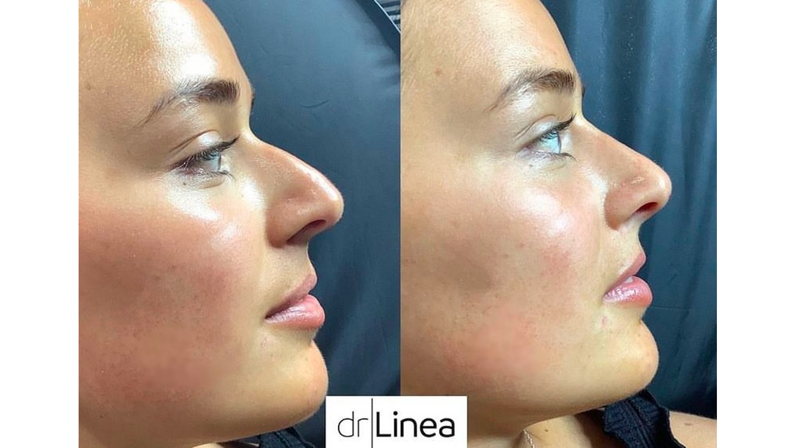 Non-surgical Rhinoplasty