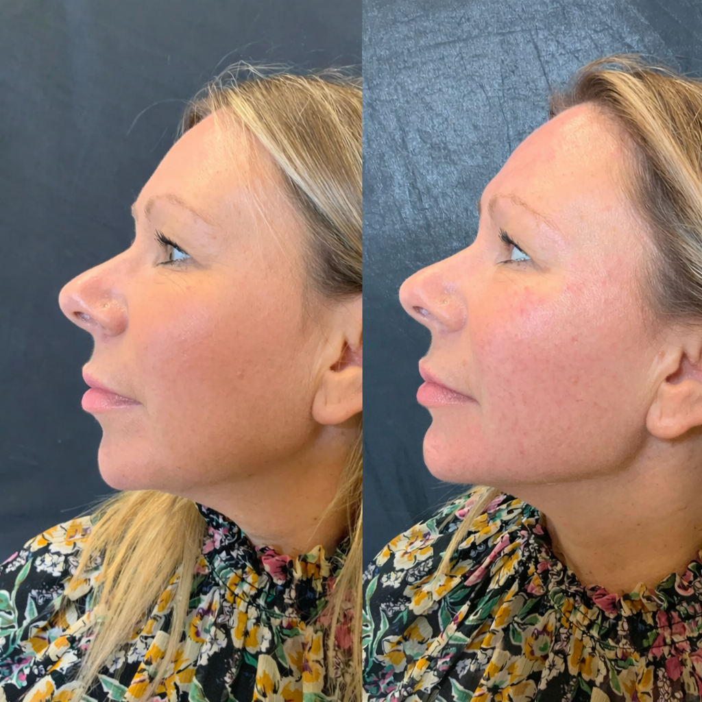 Jaw Line Dermal Fillers