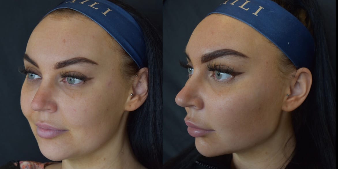Cheek Augmentation | Face | Dr Linea