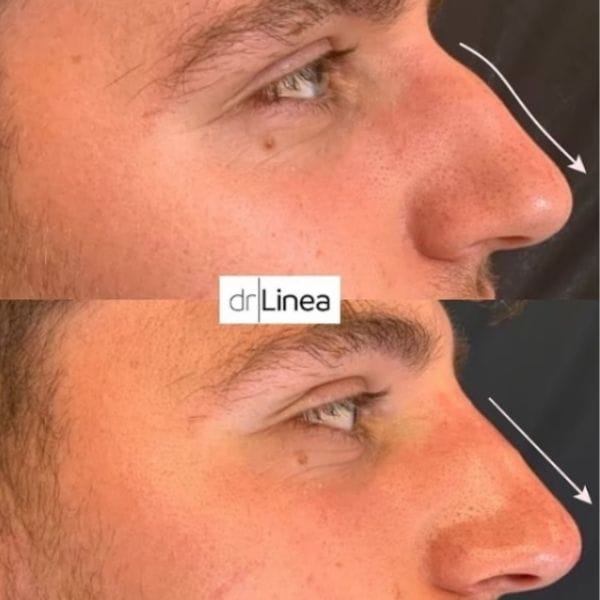 liquid nose job for men before and after