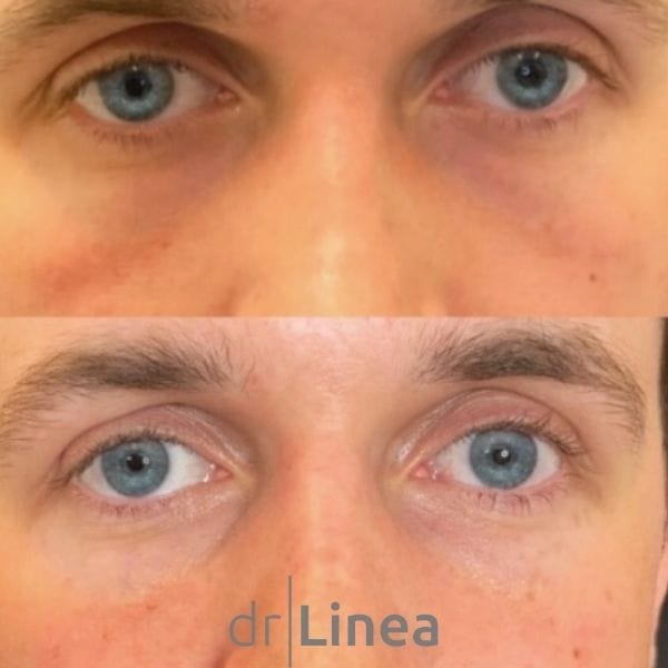 under eye tear trough filler for men before and after