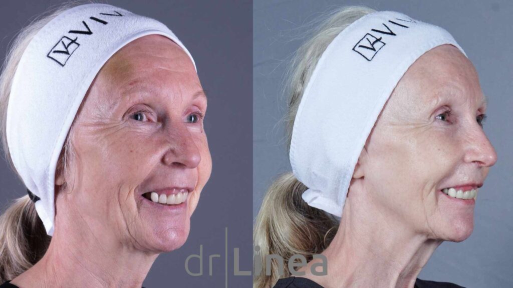 dermal filler before and after ipswich